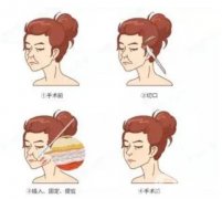 電波拉皮的作用是什么？有什么副作用嗎