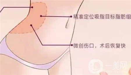 全身吸脂手術(shù)價(jià)格？馮斌做全身吸脂大概多少錢？