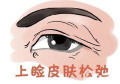 為什么眼皮會(huì)下垂？如何自我矯正？