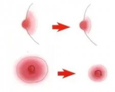 乳暈縮小術(shù)的方法？對母乳喂養(yǎng)有影響嗎？