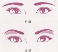 切眉后眼睛變形了怎么辦？浮腫怎么辦？