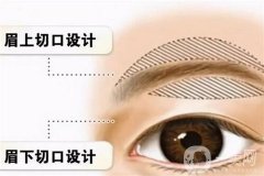 切眉有什么特點？可以做兩次切眉嗎？
