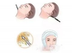 吸脂會(huì)留疤嗎?有哪些注意事項(xiàng)?