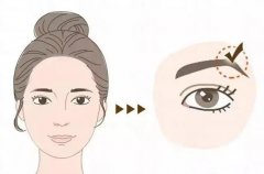 什么是切眉術(shù)？可以去除魚尾紋嗎