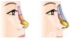 為什么耳軟骨墊鼻尖會(huì)歪斜？耳軟骨墊鼻尖后歪斜怎么辦？