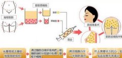 豐太陽穴的方法及注意事項(xiàng)？