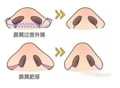 鼻翼內(nèi)切的切口在哪里？原理是什么？
