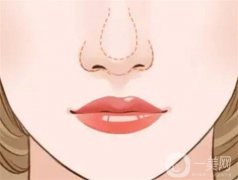 手術(shù)需要多少錢？注意事項(xiàng)有哪些？