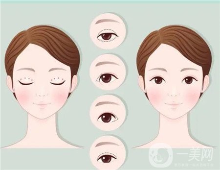 杭州格萊美醫(yī)院做雙眼皮咋樣?案例價(jià)格表公開