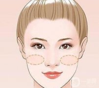 蘋果肌凹陷怎么處理？蘋果肌在哪里？