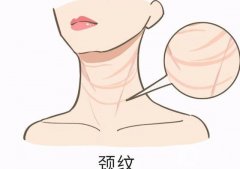 頸紋是怎么形成的？激光去除頸部皺紋后有哪些注意事項？
