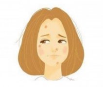 痘印可以用去除嗎？做完后需要加強防曬嗎？