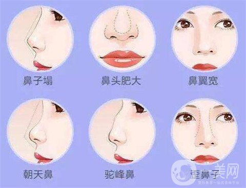 湖南省人民醫(yī)院整形美容科隆鼻*果如何？看價格表及案例實述