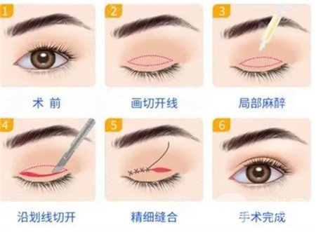 益陽市中心醫(yī)院整形美容科價格表完整版及雙眼皮修復案例瀏覽