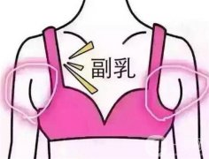 副乳切除術(shù)后恢復(fù)時(shí)間和飲食注意解答