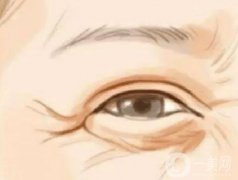 激光去除魚尾紋果如何？有什么副作用嗎