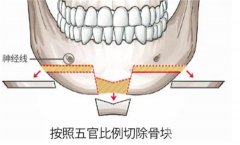 什么是切骨？需要多少費用？