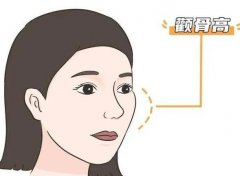 下頜角截骨術(shù)有哪些特點和風(fēng)險？適合哪個年齡？