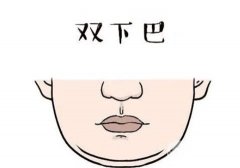 雙下巴吸脂果好不好？