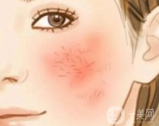 光子嫩膚去紅血絲要多少錢？