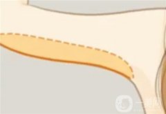 什么因素決定手臂吸脂的價(jià)格？