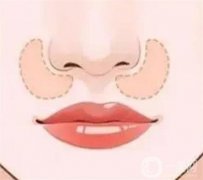 填充鼻基底的后遺癥？
