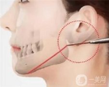 為什么下頜角不好看？介紹五種類型看看你是不是