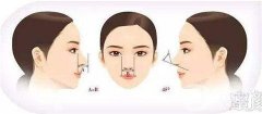 通常隆鼻后有哪些事項(xiàng)需要注意?