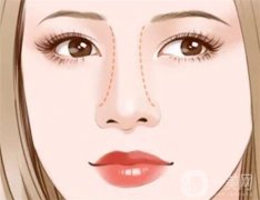 隆鼻為什么會(huì)穿孔？微創(chuàng)隆鼻危險(xiǎn)嗎？