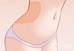 吸脂會(huì)不會(huì)出現(xiàn)反彈？吸脂后應(yīng)該注意什么呢？