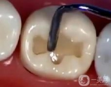 補(bǔ)牙的材料有哪些？哪種好？