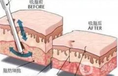 電動負壓吸脂術(shù)是怎么做的