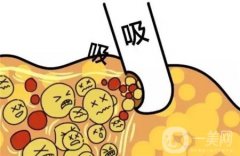 夏天能抽脂嗎，什么時候能恢復(fù)