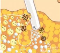 吸脂減肥嗎?會(huì)不會(huì)反彈?