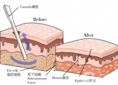 水動力吸脂有什么優(yōu)點？會留疤嗎