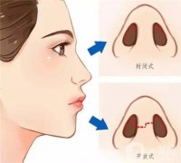 隆鼻修復(fù)有哪些方面需要注意？
