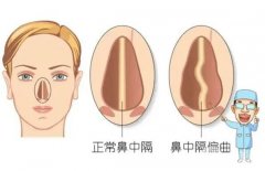 矯正鼻中隔偏曲需要多少錢？