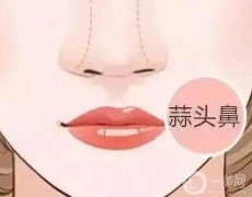 大蒜鼻應(yīng)該怎么矯正？