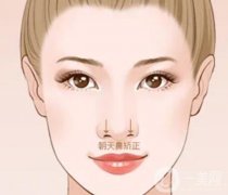 矯正朝天鼻手術是不是很復雜？