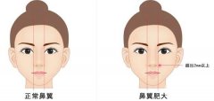 不對稱的鼻翼矯正的果好不好？