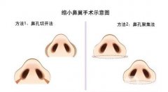 鼻翼縮小手術(shù)是如何操作的？有哪些常用方法？