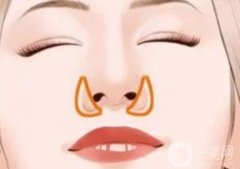 鼻翼縮小的方法有幾種？切口在哪里？