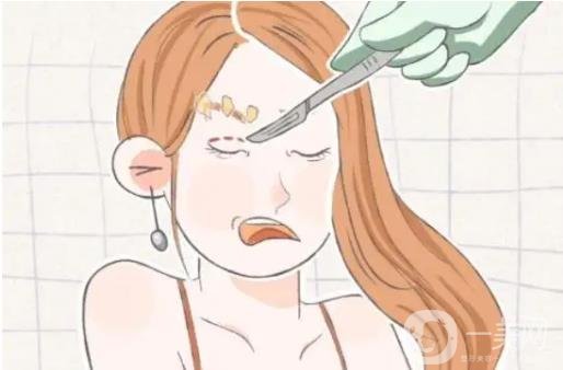 開眼角手術(shù)前后圖 開眼角注意事項