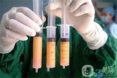 埋線減肥有什么果？多少天會瘦下來？