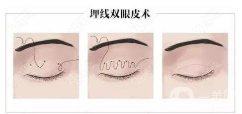 做超聲波手術(shù)去眼袋一般需要多少錢(qián)？