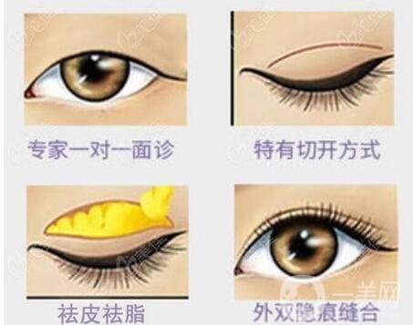 自體脂肪豐眼窩手術(shù)恢復(fù)過程介紹 術(shù)后注意一覽