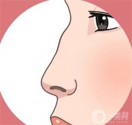 影響駝峰鼻矯正價格的因素有哪些？
