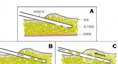 吸脂有害嗎？如何吸脂的性？
