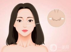 鼻翼內(nèi)切的果可以長久保持嗎？