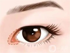 開內(nèi)外眼角有哪些區(qū)別呢？